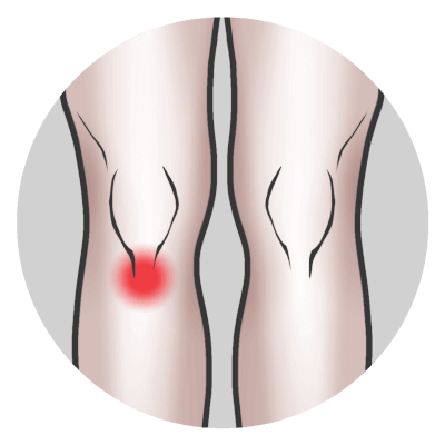 Patellaarinen tendinopatia