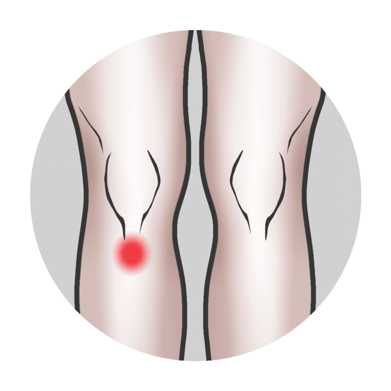 Osgood schlatterin tauti