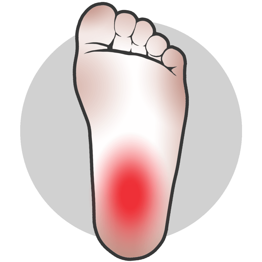 Plantaarifaskiitin kipukohta jalassa