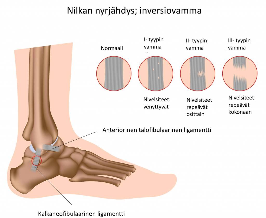 Nilkan inversiovamma